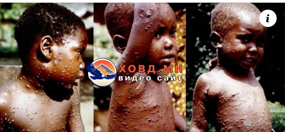 Сармагчны цэцэг өвчин бүртгэгдснийг ДЭМБ зарлалаа