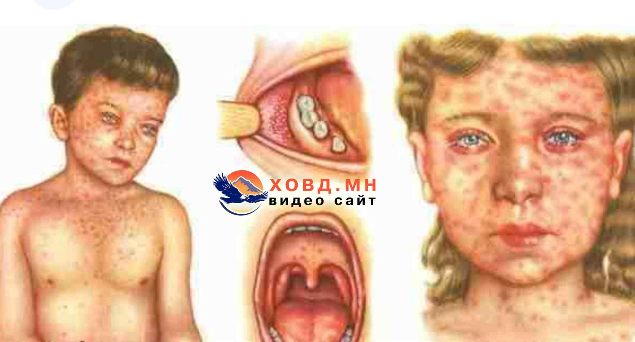 Ховд аймагт 0-1 насны 3 хүүхэд “Улаанбурхан” өвчнөөр өвчилж хэвтэн эмчлүүлж байна