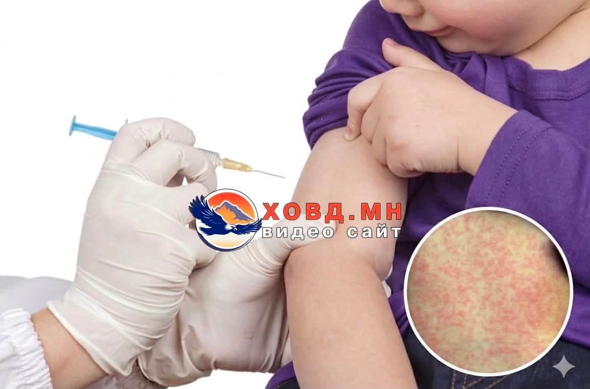 Ховд аймагт Улаанбурхан өвчний 27 тохиолдол бүртгэгджээ